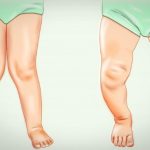 Rakitis pada Anak, Dampak Kekurangan Vitamin D