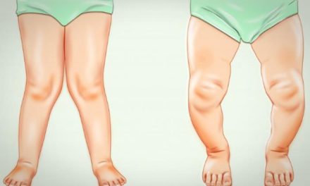 Rakitis pada Anak, Dampak Kekurangan Vitamin D