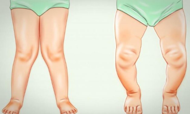 Rakitis pada Anak, Dampak Kekurangan Vitamin D