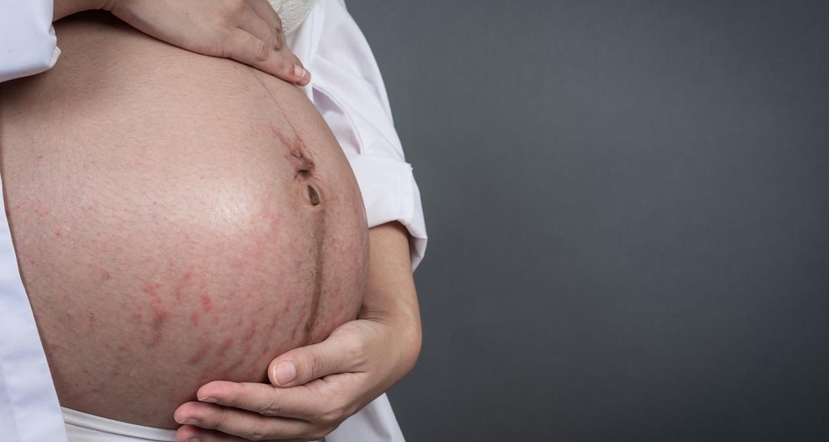 Selulit Atau Stretch Mark Sering Terjadi Pada Ibu Hamil