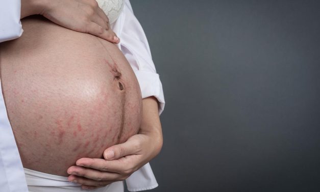 Selulit Atau Stretch Mark Sering Terjadi Pada Ibu Hamil