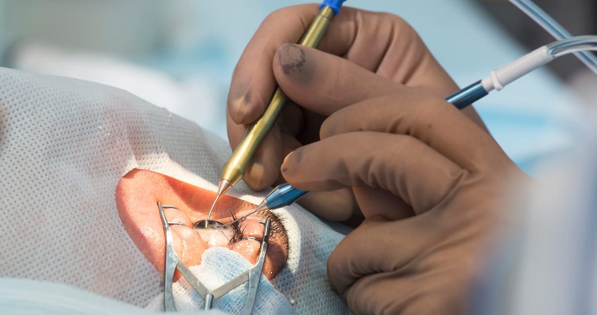 Informasi Rinci Tentang Lasik Mata Yang Wajib Di Pahami