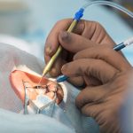 Informasi Rinci Tentang Lasik Mata Yang Wajib Di Pahami